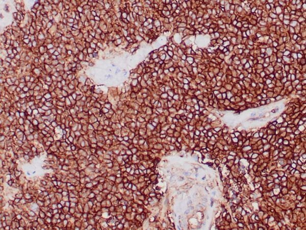 Immunohistochemistry (IHC) : Formalin-fixed, paraffin-embedded human Ewing’s sarcoma stained with clone ZM139 antibody using peroxidase-conjugate and DAB chromogen. Note the cell membrane staining of tumor cells