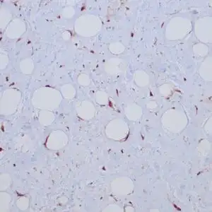 Immunohistochemistry (IHC) : Formalin-fixed, paraffin-embedded human liposarcoma stained with anti-CDK4 antibody using peroxidase-conjugate and DAB chromogen. Note nuclear/cytoplasmic staining of tumor cells.