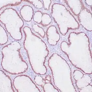 Immunohistochemistry (IHC) : Human colon adenocarcinoma stained with anti-CDX-2 antibody using peroxidase-conjugate and DAB chromogen. Note the nuclear staining of tumor cells .