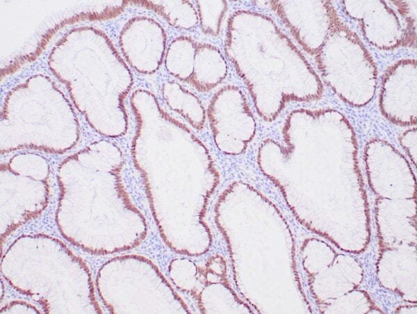 Immunohistochemistry (IHC) : Human colon adenocarcinoma stained with anti-CDX-2 antibody using peroxidase-conjugate and DAB chromogen. Note the nuclear staining of tumor cells .