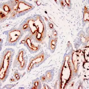 Immunohistochemistry (IHC) : Human colon carcinoma stained with anti-CEA monoclonal antibody using peroxidase-conjugate and DAB chromogen. Note cytoplasmic and luminal surface staining of tumor cells.