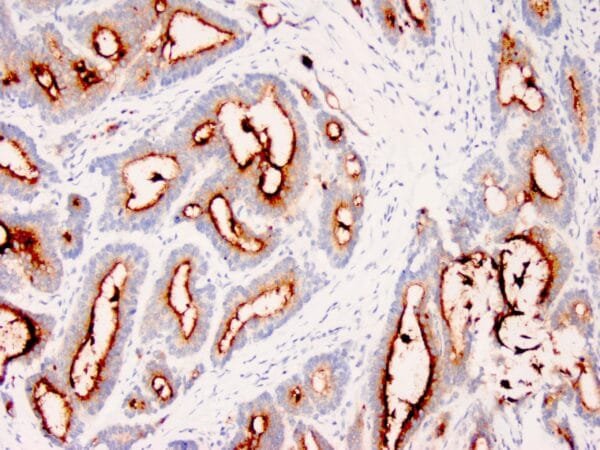 Immunohistochemistry (IHC) : Human colon carcinoma stained with anti-CEA monoclonal antibody using peroxidase-conjugate and DAB chromogen. Note cytoplasmic and luminal surface staining of tumor cells.