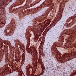 Immunohistochemistry (IHC) : Formalin-fixed, paraffin-embedded human colon carcinoma stained with anti-CEACAM5 polyclonal antibody using peroxidase-conjugate and DAB chromogen. Note cytoplasmic and luminal surface staining of tumor cells