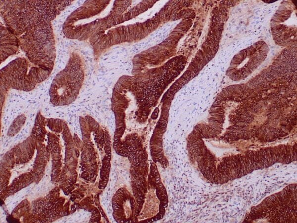 Immunohistochemistry (IHC) : Formalin-fixed, paraffin-embedded human colon carcinoma stained with anti-CEACAM5 polyclonal antibody using peroxidase-conjugate and DAB chromogen. Note cytoplasmic and luminal surface staining of tumor cells