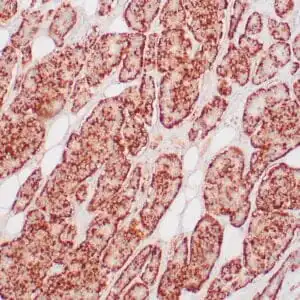 Immunohistochemistry (IHC) : Human neuroendocrine tumor stained with anti-Chromogranin A antibody using peroxidase-conjugate and DAB chromogen. Note cytoplasmic tumor cells.