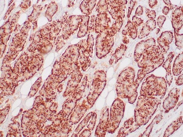 Immunohistochemistry (IHC) : Human neuroendocrine tumor stained with anti-Chromogranin A antibody using peroxidase-conjugate and DAB chromogen. Note cytoplasmic tumor cells.