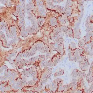Immunohistochemistry (IHC) : Formalin-fixed, paraffin-embedded human gastric adenocarcinoma stained with anti-claudin 18.2 antibody using peroxidase-conjugate and DAB chromogen. Note the membranous staining of tumor cells