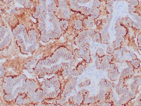 Immunohistochemistry (IHC) : Formalin-fixed, paraffin-embedded human gastric adenocarcinoma stained with anti-claudin 18.2 antibody using peroxidase-conjugate and DAB chromogen. Note the membranous staining of tumor cells