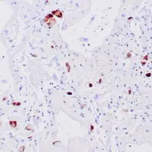 Immunohistochemistry (IHC) : Human CMV infected lung stained with anti-CMV antibody using peroxidase-conjugate and DAB chromogen. Note nuclear staining of infected alveolar cells.