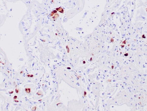 Immunohistochemistry (IHC) : Human CMV infected lung stained with anti-CMV antibody using peroxidase-conjugate and DAB chromogen. Note nuclear staining of infected alveolar cells.