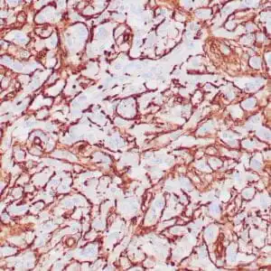 Immunohistochemistry (IHC) : Human glomus tumor stained with anti-Collagen IV using peroxidase-conjugate and DAB chromogen. Note basement membrane staining of around individual cells.