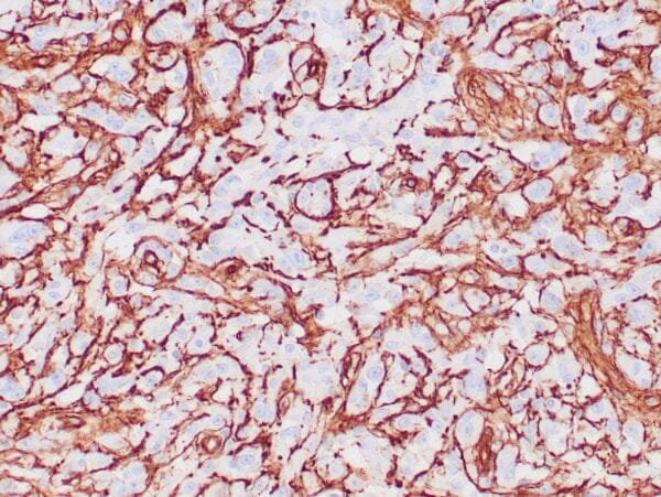 Immunohistochemistry (IHC) : Human glomus tumor stained with anti-Collagen IV using peroxidase-conjugate and DAB chromogen. Note basement membrane staining of around individual cells.