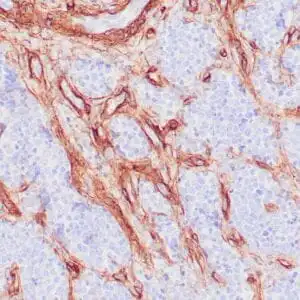 Immunohistochemistry (IHC) : Human glomus tumor stained with anti-Collagen IV using peroxidase-conjugate and DAB chromogen. Note basement membrane staining of around individual cells.