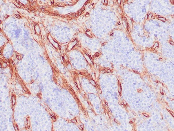 Immunohistochemistry (IHC) : Human glomus tumor stained with anti-Collagen IV using peroxidase-conjugate and DAB chromogen. Note basement membrane staining of around individual cells.