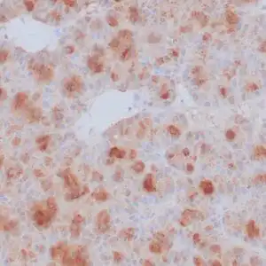 Immunohistochemistry (IHC) : Formalin-fixed, paraffin-embedded human pancreatic acinar cell carcinoma stained with anti-CPA1 antibody using peroxidase-conjugate and DAB chromogen. Note the cytoplasmic staining of tumor cells