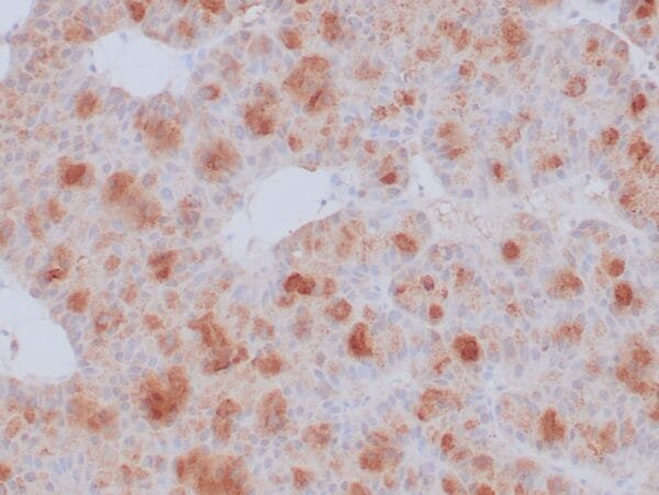 Immunohistochemistry (IHC) : Formalin-fixed, paraffin-embedded human pancreatic acinar cell carcinoma stained with anti-CPA1 antibody using peroxidase-conjugate and DAB chromogen. Note the cytoplasmic staining of tumor cells