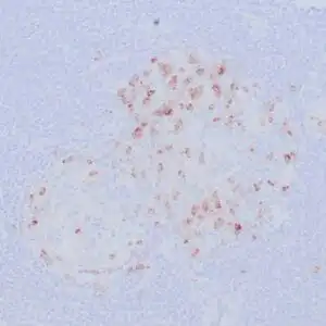 Immunohistochemistry (IHC) : Formalin-fixed, paraffin-embedded human tonsil stained with anti-CTLA4 antibody using peroxidase-conjugate and DAB chromogen. Note the cytoplasmic staining of cytotoxic T-cells