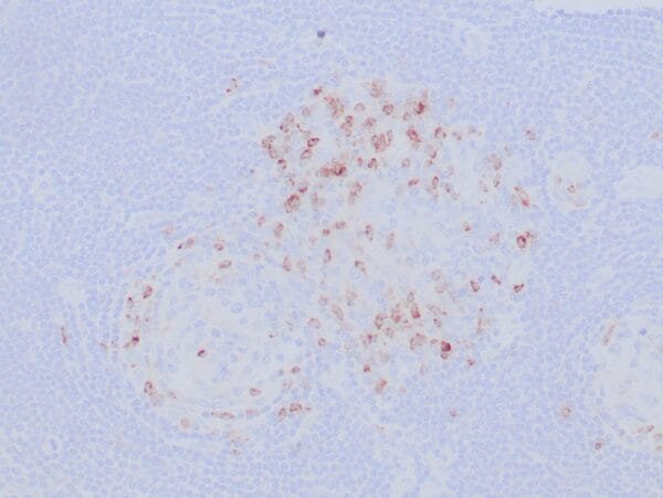 Immunohistochemistry (IHC) : Formalin-fixed, paraffin-embedded human tonsil stained with anti-CTLA4 antibody using peroxidase-conjugate and DAB chromogen. Note the cytoplasmic staining of cytotoxic T-cells