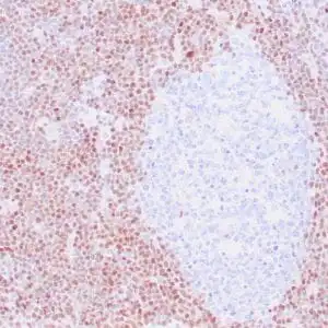 Immunohistochemistry (IHC) : Human mantle cell lymphoma stained with anti-Cyclin D1 antibody using peroxidase-conjugate and DAB chromogen. Note the nuclear staining of lymphoma cells.