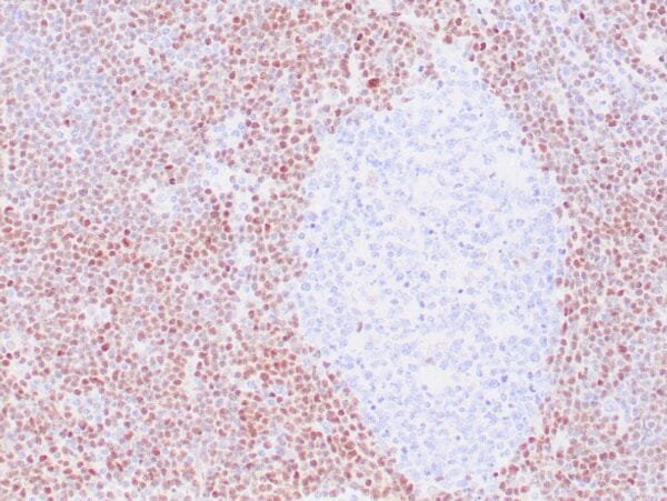 Immunohistochemistry (IHC) : Human mantle cell lymphoma stained with anti-Cyclin D1 antibody using peroxidase-conjugate and DAB chromogen. Note the nuclear staining of lymphoma cells.