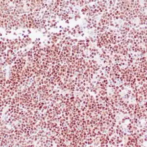 Immunohistochemistry (IHC) : Human mantle cell lymphoma stained with anti-Cyclin D1 antibody using peroxidase-conjugate and DAB chromogen. Note the nuclear staining of lymphoma cells.