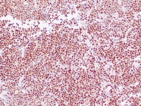 Immunohistochemistry (IHC) : Human mantle cell lymphoma stained with anti-Cyclin D1 antibody using peroxidase-conjugate and DAB chromogen. Note the nuclear staining of lymphoma cells.