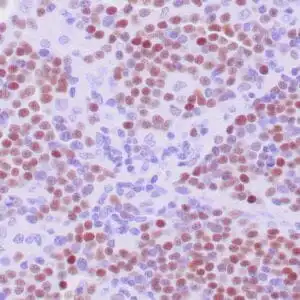 Immunohistochemistry (IHC) : Human colon carcinoma stained with anti-Cyclin D1 antibody using peroxidase-conjugate and DAB chromogen. Note the nuclear staining of tumor cells.