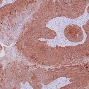 Immunohistochemistry (IHC) : Formalin-fixed, paraffin-embedded human squamous cell carcinoma stained with CK14 using  peroxidase-conjugate and DAB chromogen. Note the cytoplasmic staining of squamous cells
