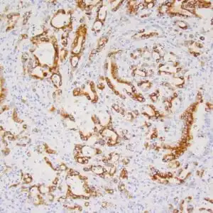 Immunohistochemistry (IHC) : Human pancreatic ductal carcinoma stained with anti-keratin 17 antibody using peroxidase-conjugate and DAB chromogen. Note the cytoplasmic staining of tumor cells.