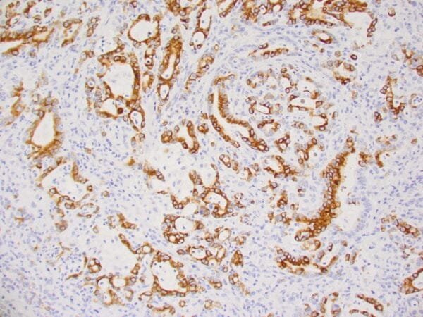 Immunohistochemistry (IHC) : Human pancreatic ductal carcinoma stained with anti-keratin 17 antibody using peroxidase-conjugate and DAB chromogen. Note the cytoplasmic staining of tumor cells.