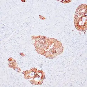 Immunohistochemistry (IHC) : Human colon carcinoma stained with anti-keratin 18 antibody using peroxidase-conjugate and DAB chromogen. Note the cytoplasmic staining of tumor glands.