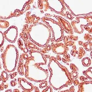 Immunohistochemistry (IHC) : Human thyroid gland stained with anti-keratin 18 antibody using peroxidase-conjugate and DAB chromogen. Note the cytoplasmic staining of glandular cells.
