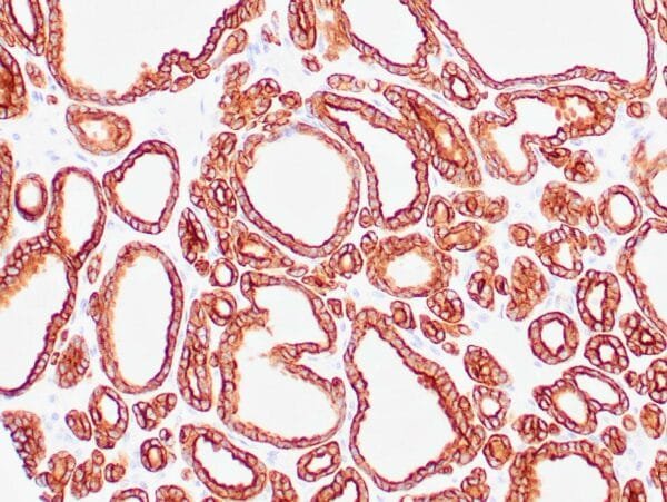 Immunohistochemistry (IHC) : Human thyroid gland stained with anti-keratin 18 antibody using peroxidase-conjugate and DAB chromogen. Note the cytoplasmic staining of glandular cells.