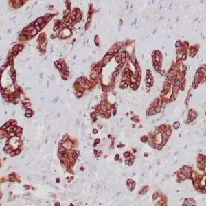 Immunohistochemistry (IHC) : Formalin-fixed, paraffin-embedded human pancreatic ductal carcinoma stained with anti-keratin 19 antibody using peroxidase-conjugate and DAB chromogen. Note the cytoplasmic staining of tumor cells