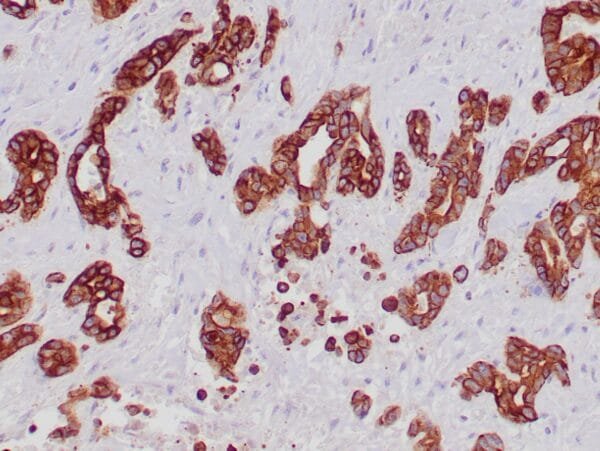 Immunohistochemistry (IHC) : Formalin-fixed, paraffin-embedded human pancreatic ductal carcinoma stained with anti-keratin 19 antibody using peroxidase-conjugate and DAB chromogen. Note the cytoplasmic staining of tumor cells