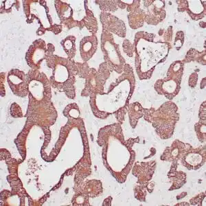 Immunohistochemistry (IHC) : Human colon carcinoma stained with anti-keratin 20 antibody using peroxidase-conjugate and DAB chromogen. Note the cytoplasmic staining of carcinoma glands.