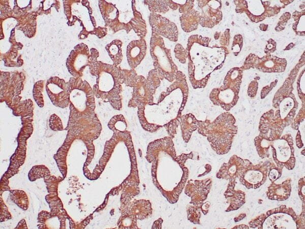 Immunohistochemistry (IHC) : Human colon carcinoma stained with anti-keratin 20 antibody using peroxidase-conjugate and DAB chromogen. Note the cytoplasmic staining of carcinoma glands.