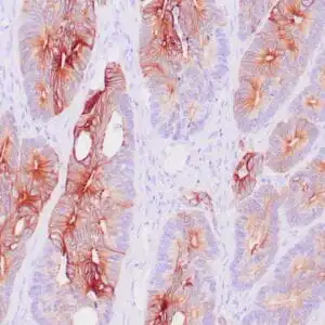 Immunohistochemistry (IHC) : Human colon carcinoma stained with anti-keratin 20 antibody using peroxidase-conjugate and DAB chromogen. Note the cytoplasmic staining of carcinoma glands.