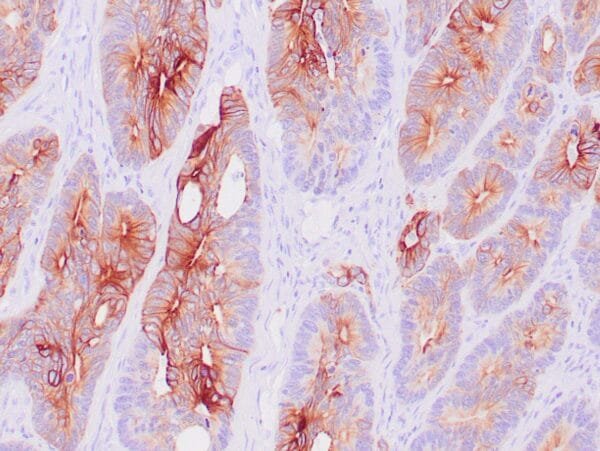 Immunohistochemistry (IHC) : Human colon carcinoma stained with anti-keratin 20 antibody using peroxidase-conjugate and DAB chromogen. Note the cytoplasmic staining of carcinoma glands.