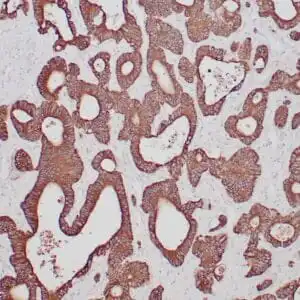 Immunohistochemistry (IHC) : Human colon carcinoma stained with anti-keratin 20 antibody using peroxidase-conjugate and DAB chromogen. Note the cytoplasmic staining of carcinoma glands.