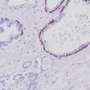 Immunohistochemistry (IHC) : Formalin-fixed, paraffin-embedded human prostate stained with anti-keratin 5 antibody using peroxidase-conjugate and DAB chromogen. Note the cytoplasmic staining of basal cells in normal glands and negative stain in prostate carcinoma