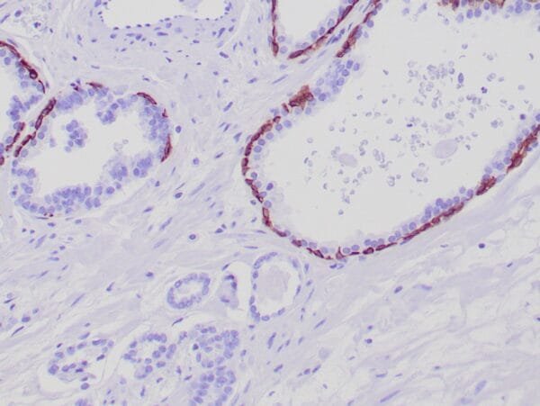 Immunohistochemistry (IHC) : Formalin-fixed, paraffin-embedded human prostate stained with anti-keratin 5 antibody using peroxidase-conjugate and DAB chromogen. Note the cytoplasmic staining of basal cells in normal glands and negative stain in prostate carcinoma