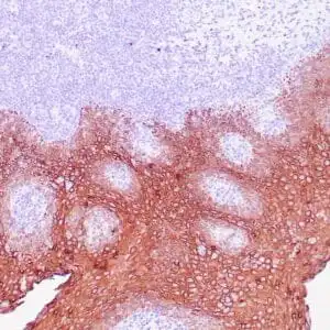 Immunohistochemistry (IHC) : Human tonsil with anti-Keratin 5 antibody using peroxidase-conjugate and DAB chromogen. Note the cytoplasmic staining of squamous epithelium.