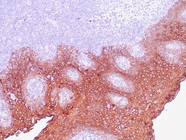 Immunohistochemistry (IHC) : Human tonsil with anti-Keratin 5 antibody using peroxidase-conjugate and DAB chromogen. Note the cytoplasmic staining of squamous epithelium.