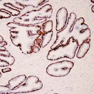 Immunohistochemistry (IHC) : Human prostate tissue stained with anti-Keratin 5/6 antibody using peroxidase-conjugate and DAB chromogen. Note the cytoplasmic staining of basal cells.