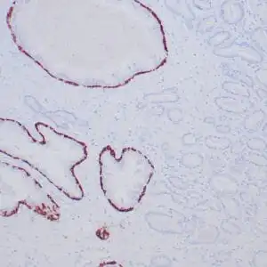 Immunohistochemistry (IHC) : Formalin-fixed, paraffin-embedded human prostate carcinoma stained with anti-cytokeratin 5/6 antibody using peroxidase-conjugate and DAB chromogen. Note the cytoplasmic staining of basal cells in the normal prostate (left), whereas carcinoma glands (right) are negative.