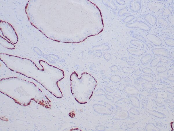 Immunohistochemistry (IHC) : Formalin-fixed, paraffin-embedded human prostate carcinoma stained with anti-cytokeratin 5/6 antibody using peroxidase-conjugate and DAB chromogen. Note the cytoplasmic staining of basal cells in the normal prostate (left), whereas carcinoma glands (right) are negative.