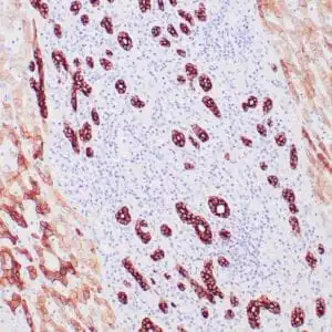 Immunohistochemistry (IHC) : Human basal cell carcinoma stained with anti-keratin 8 antibody using peroxidase-conjugate and DAB chromogen. Note the cytoplasmic staining of tumor cells.