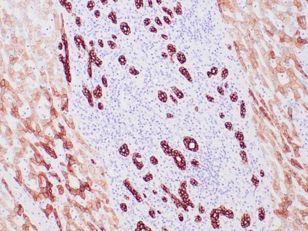 Immunohistochemistry (IHC) : Human basal cell carcinoma stained with anti-keratin 8 antibody using peroxidase-conjugate and DAB chromogen. Note the cytoplasmic staining of tumor cells.