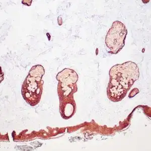 Immunohistochemistry (IHC) : Human skin with carcinoma stained with anti-HMW, CK antibody using peroxidase-conjugate and DAB chromogen. Note membrane and cytoplasmic staining of squamous epithelium.